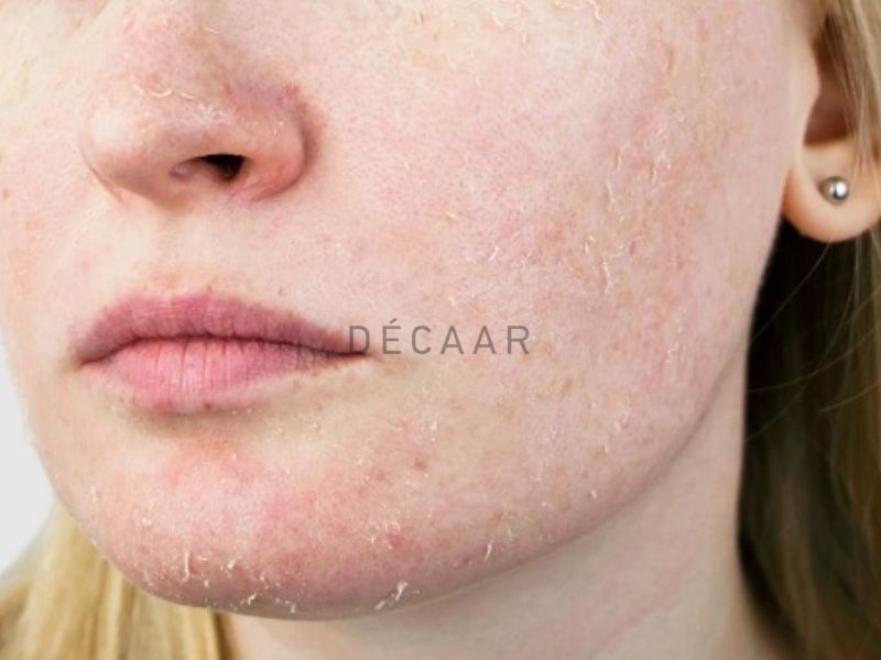 Tác dụng phụ và biến chứng sau peel da